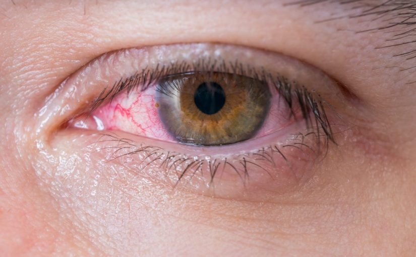 7 Penyebab Mata Merah yang Jarang Diketahui
